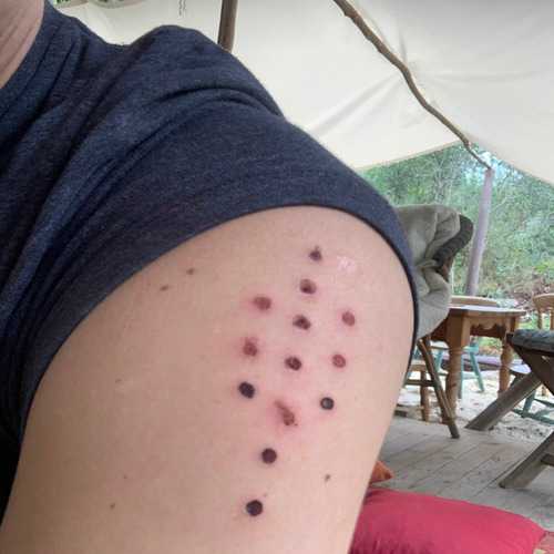 The skin was burned, and the medicine applied through the dots